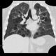Lymphocytic interstitial pneumonia, cystic lung disease: CT - Computed tomography